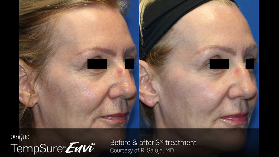 Tempure before & after | Phoenician Eye Specialists