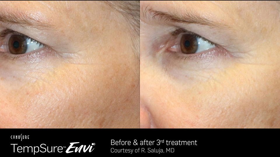 Tempure before & after | Phoenician Eye Specialists